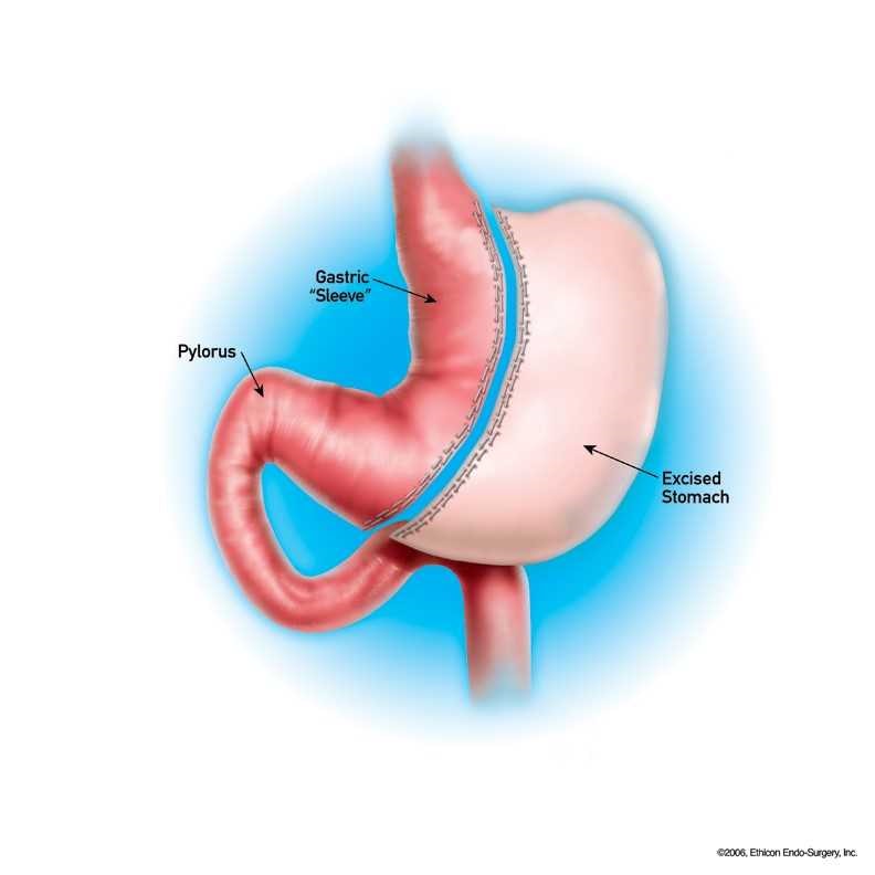 Bariatric surgery