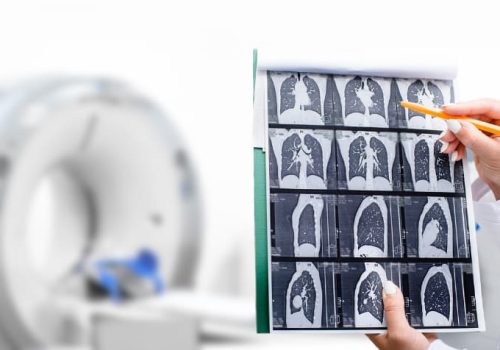 Understanding the Signs of Lung Cancer and When to Talk to Your Physician