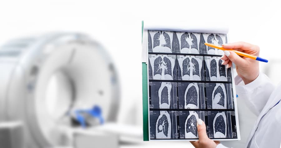 Lung Cancer Imaging