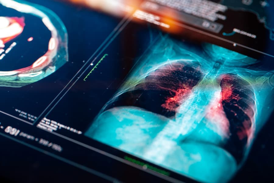 Medical MRI Scan Of Lungs, Shown On A Digital Screen