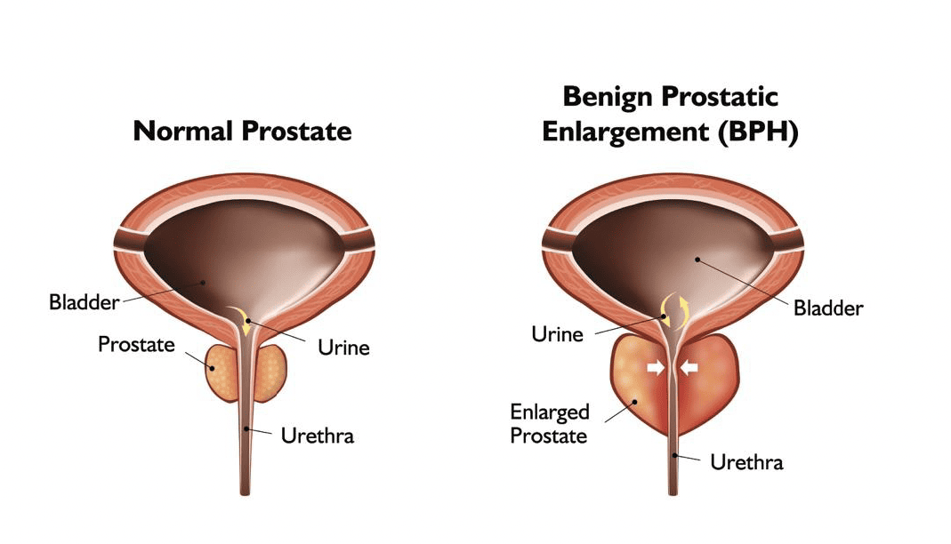 Benign Prostatic Hyperplasia (BPH) - Richmond University Medical Center