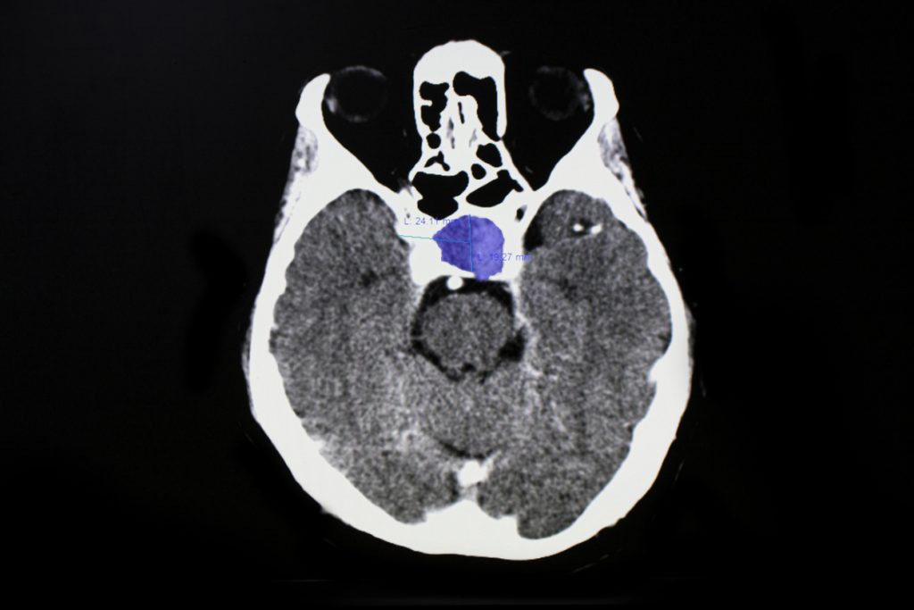 CT scan of patient with pituitary tumor